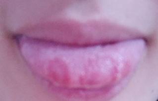 吃网红瓜舌头怎么会痛,揭秘饮食健康新警示